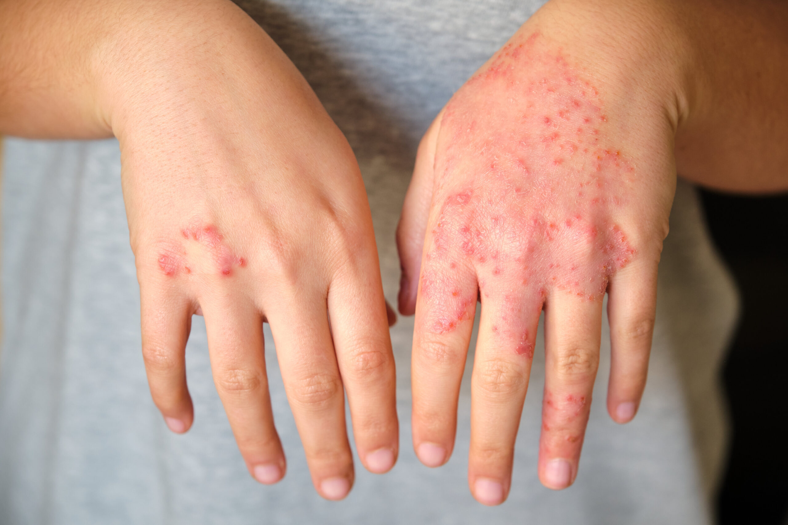 Home unrecognizable woman with eczema on hands, atopic dermatitis.